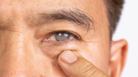 Essential Care Tips After Cataract Surgery