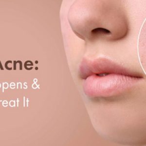 Adult Acne – Causes, treatments etc – Various important things to know!!