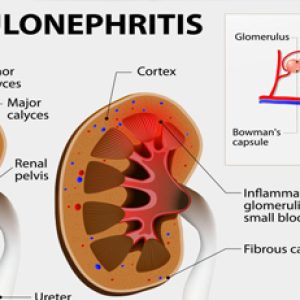 What is glomerulonephritis – Its causes, symptoms, treatment etc!!