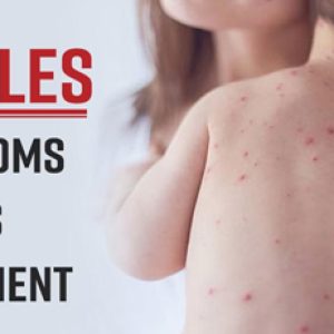 Be careful!! Know about these scary health issues that can affect you after you get measles!!