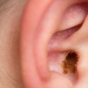 Earwax Buildup and Blockage