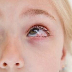 Eye Infection: Symptoms, Causes, Treatment & Prevention