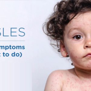 Be careful!! Know about these scary health issues that can affect you after you get measles!!